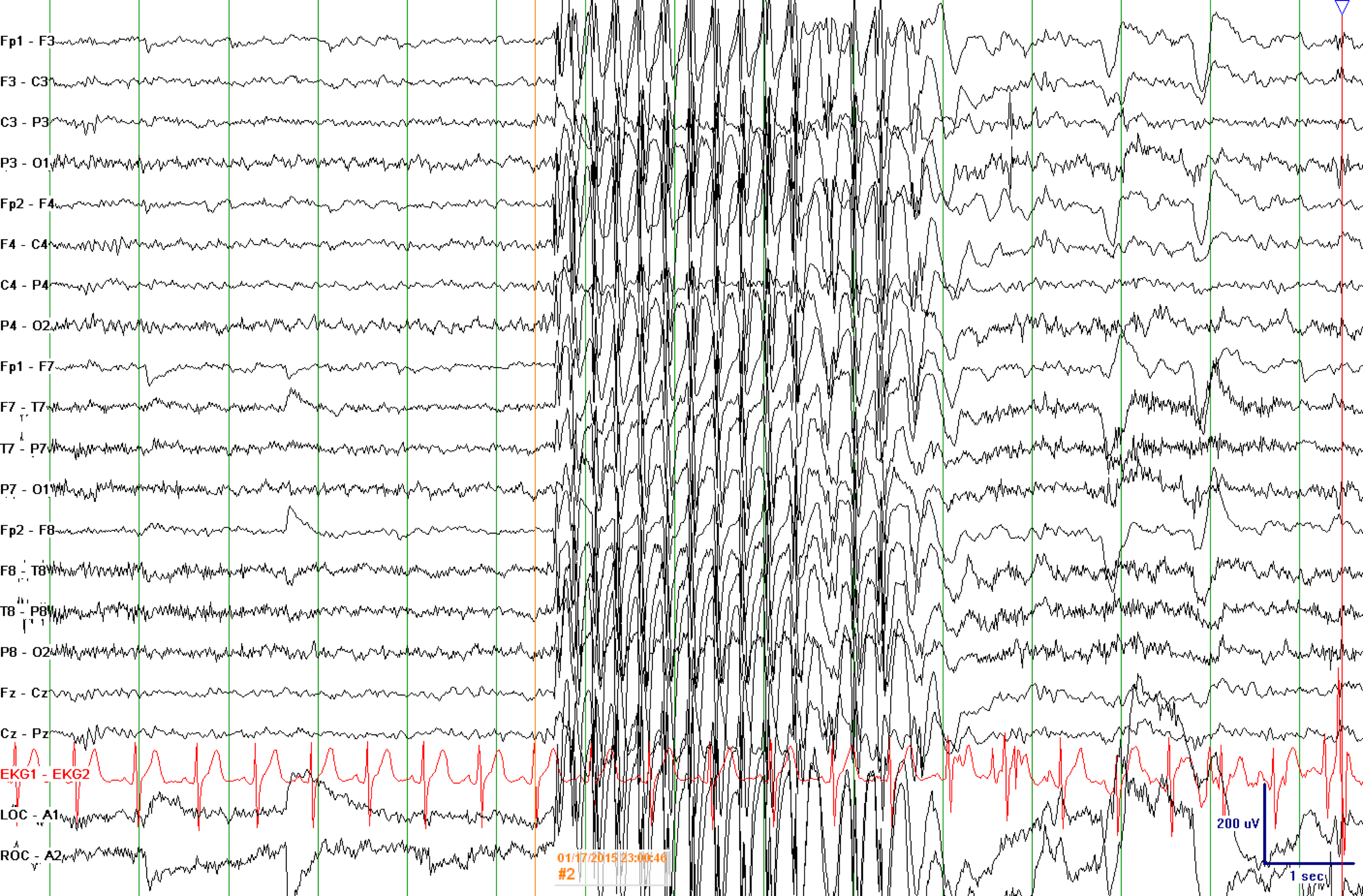 EEG 3 To 6