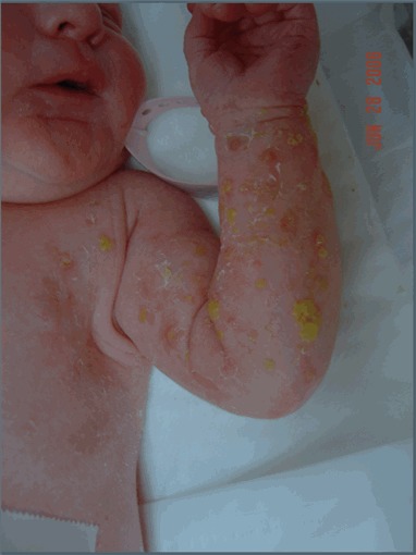 incontinentia Stage1