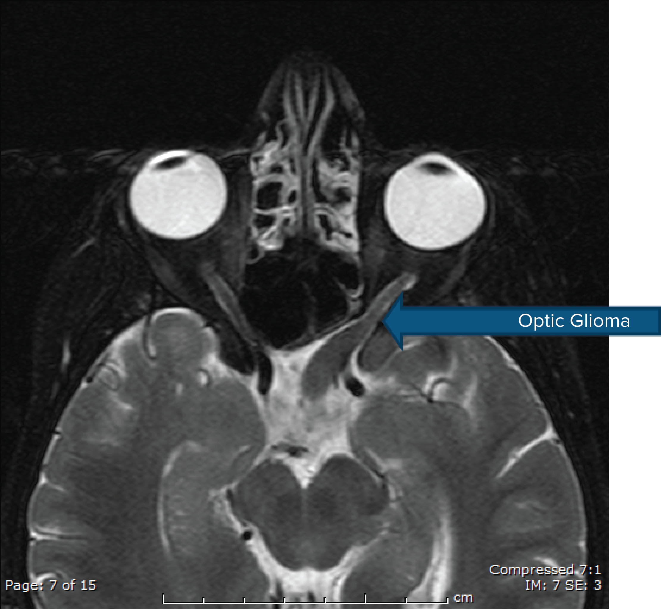 Optic Glioma