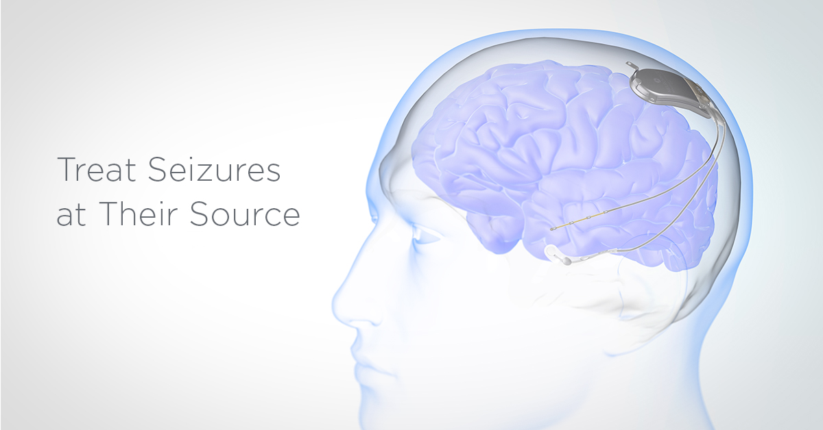 Treat Seizures at Their Source